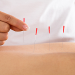 dry needling physical therapy