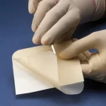 Hydrocolloid Dressing for 2nd Degree Burns